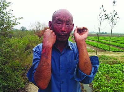 气球飘千里炸伤村民疑收割机火花引发爆炸(图)
